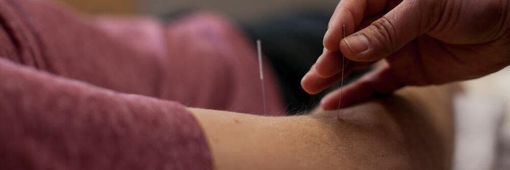 Acupuncture Services