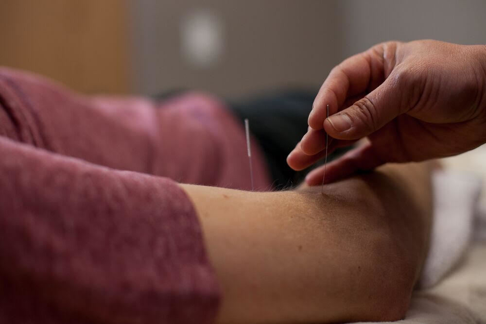 Acupuncture Services